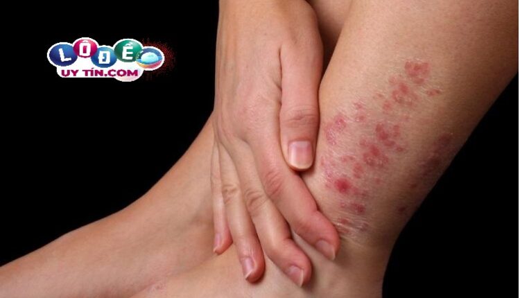 Nằm mơ thấy bị ghẻ lở là điềm gì? Đánh số nào? 2 Nằm mơ thấy bị ghẻ lở là điềm gì? Đánh số nào?
