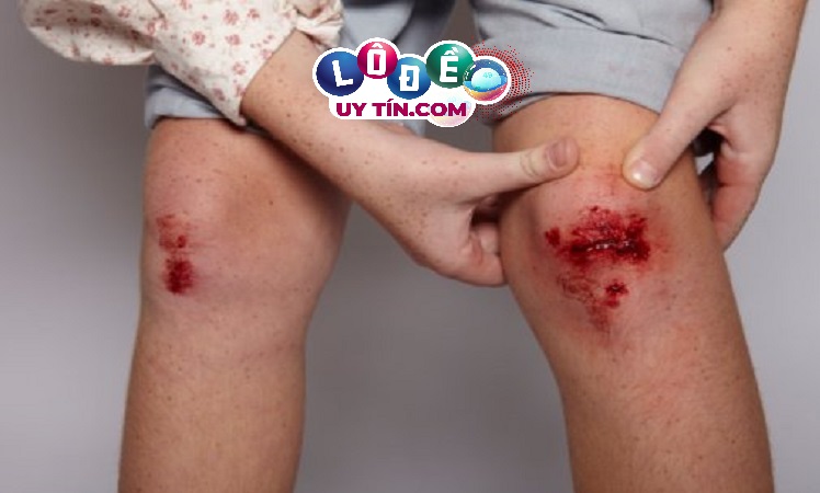 Điềm báo mơ thấy chảy máu chân đánh con gì? Có ý nghĩa gì? 2 Điềm báo mơ thấy chảy máu chân đánh con gì