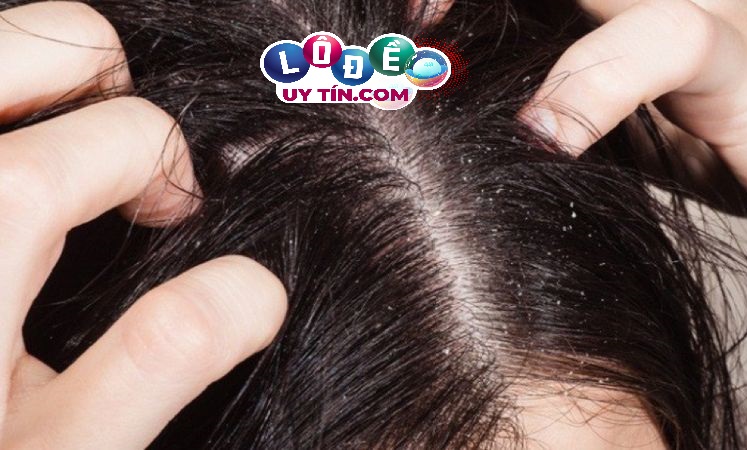 Giải mã giấc mơ thấy đầu có chấy - Số nào may mắn? 3 Giải mã giấc mơ thấy đầu có chấy - Số nào may mắn 2