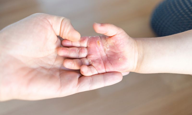 Nằm mơ thấy bị bỏng đánh lô như thế nào cho hợp lý? 4 Nằm mơ thấy bị bỏng đánh lô như thế nào cho hợp lý?